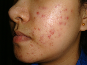 Acne Prevention What To Do And Not To Do